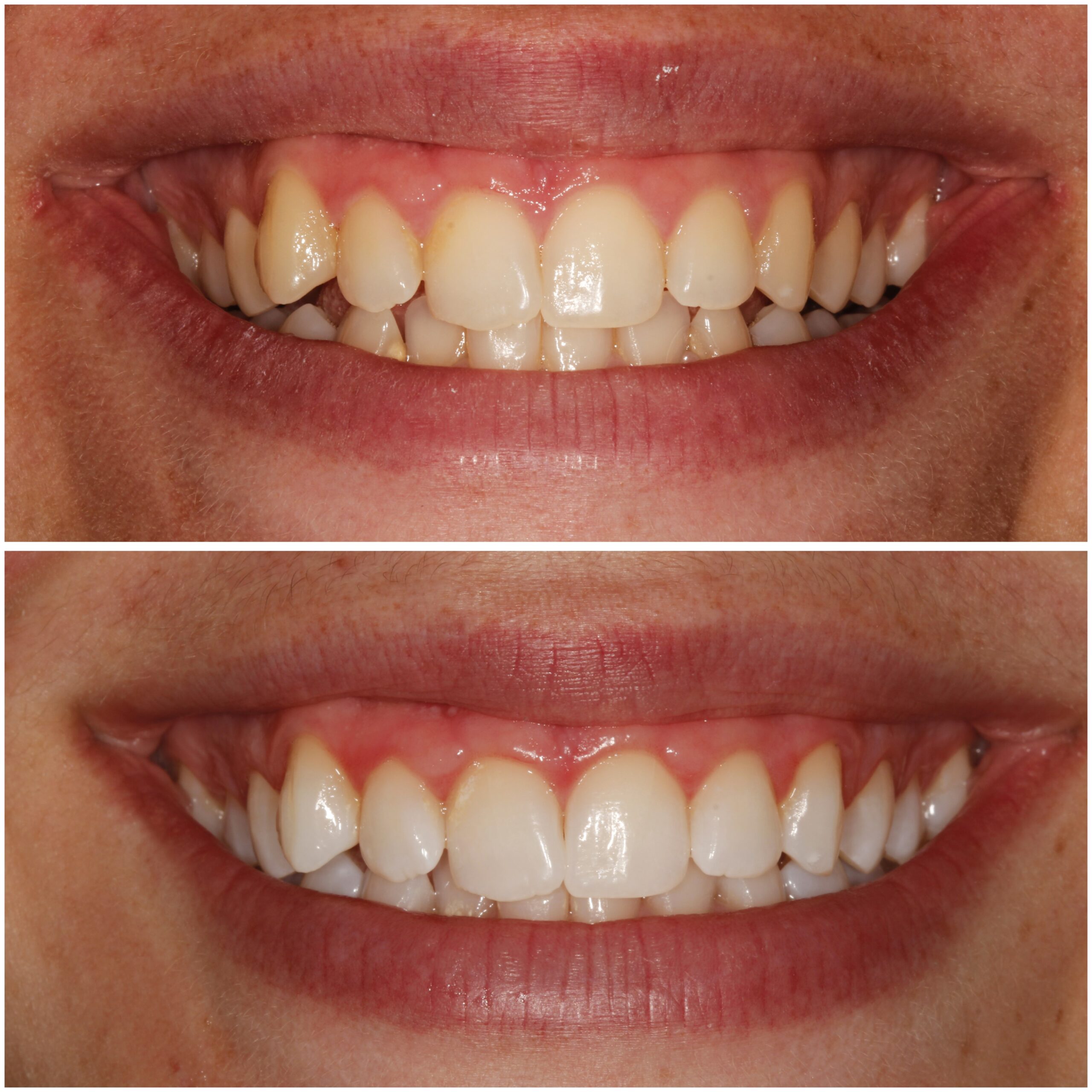 Teeth Whitening Marylebone