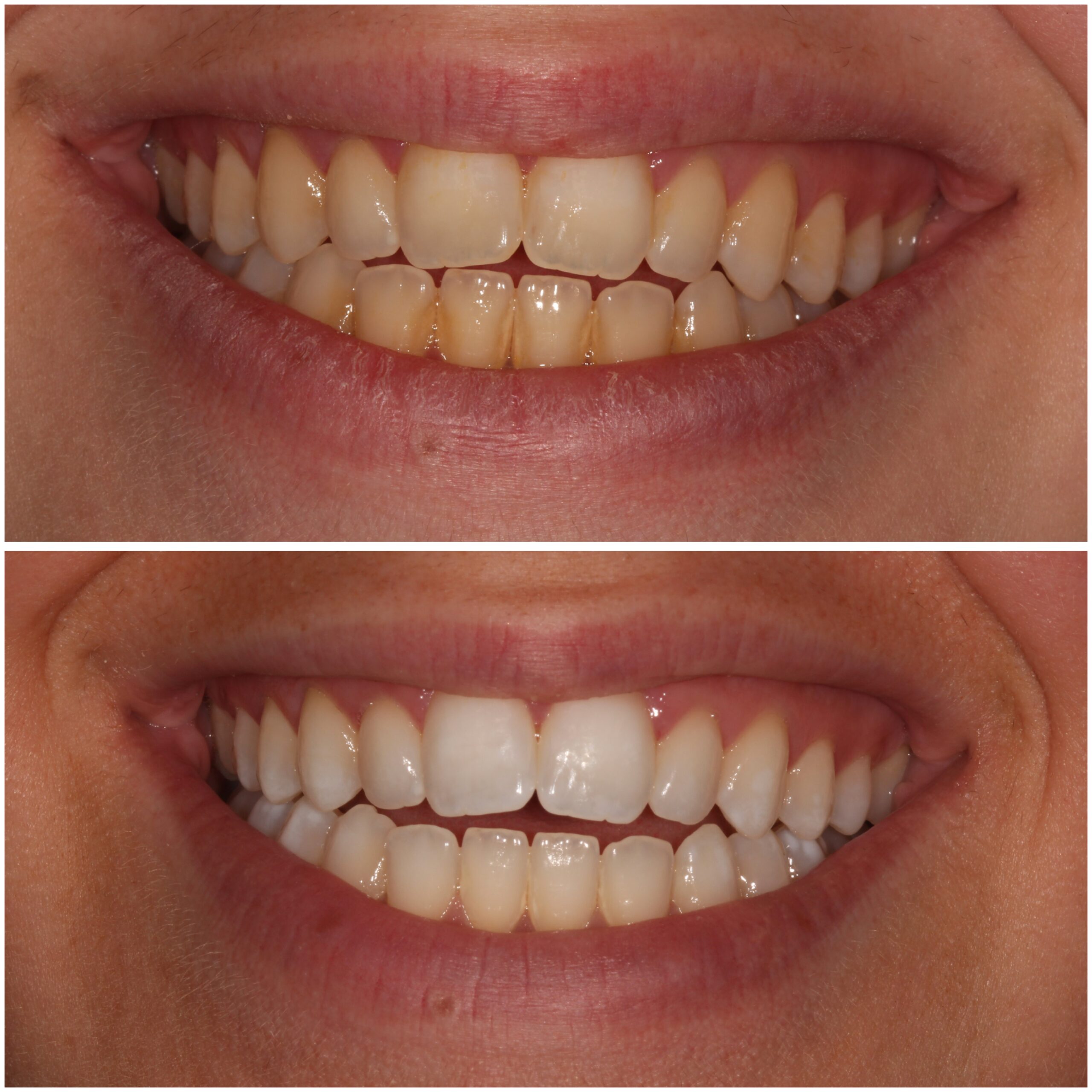 Teeth Whitening Marylebone