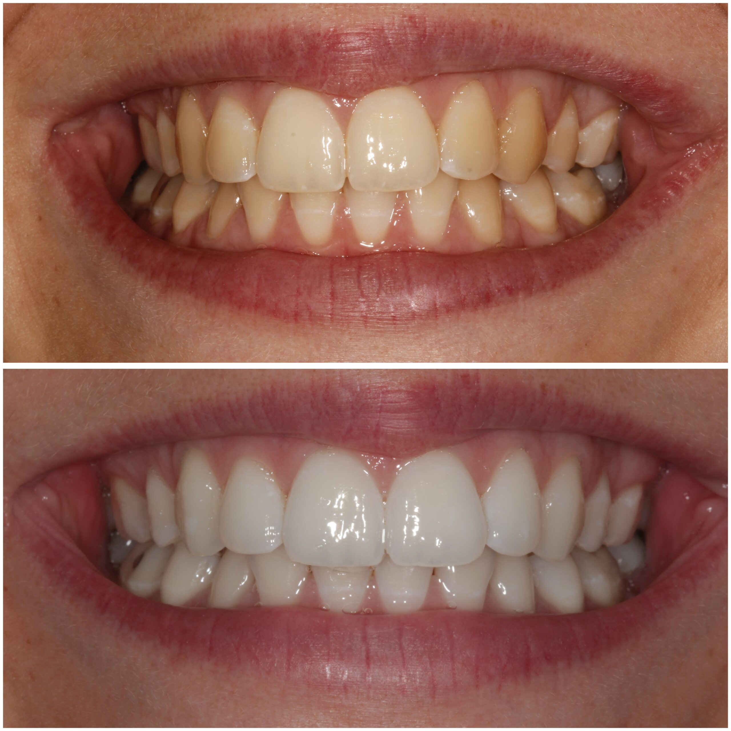 Teeth Whitening Marylebone