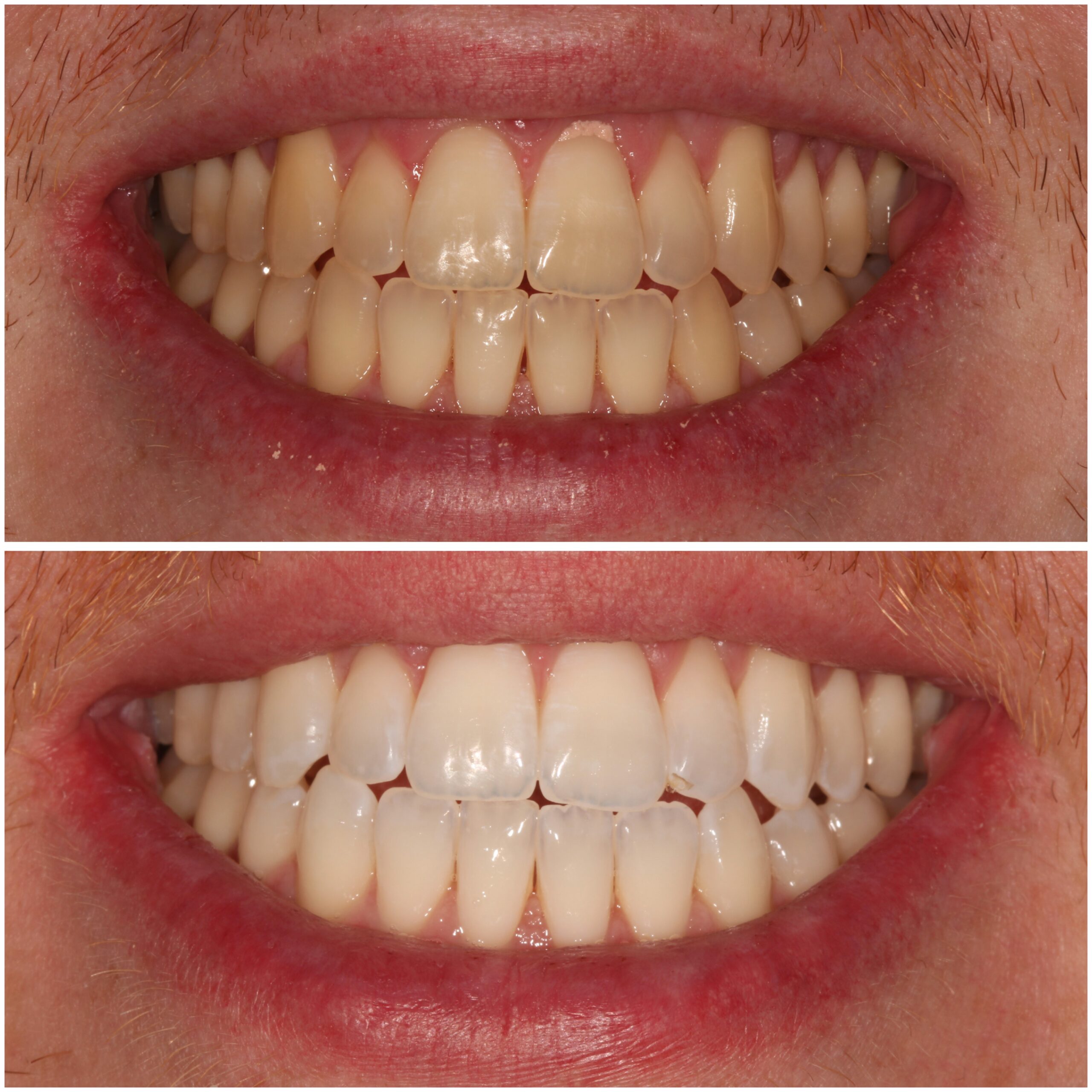 Teeth Whitening Marylebone