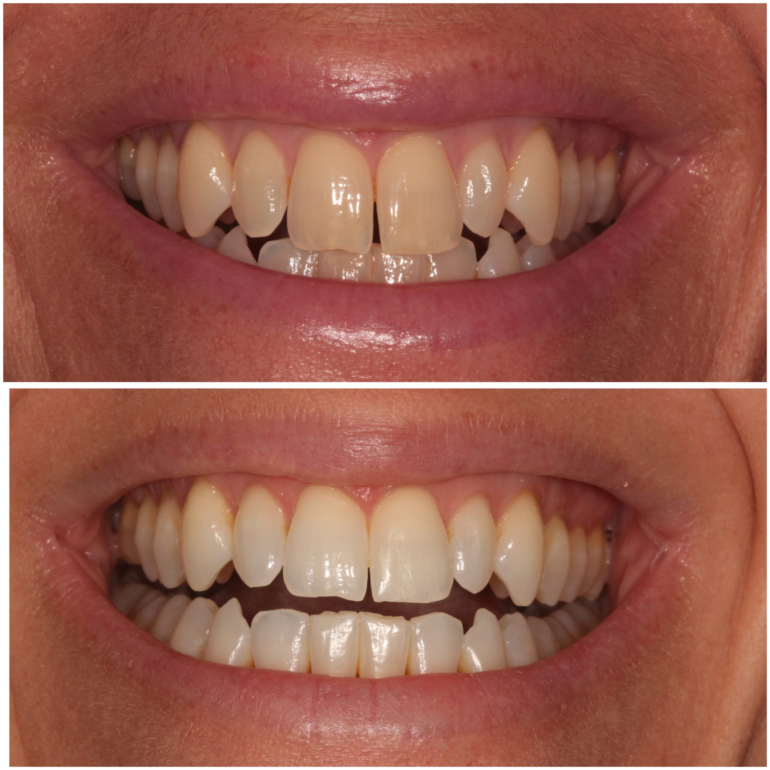Teeth Whitening Marylebone