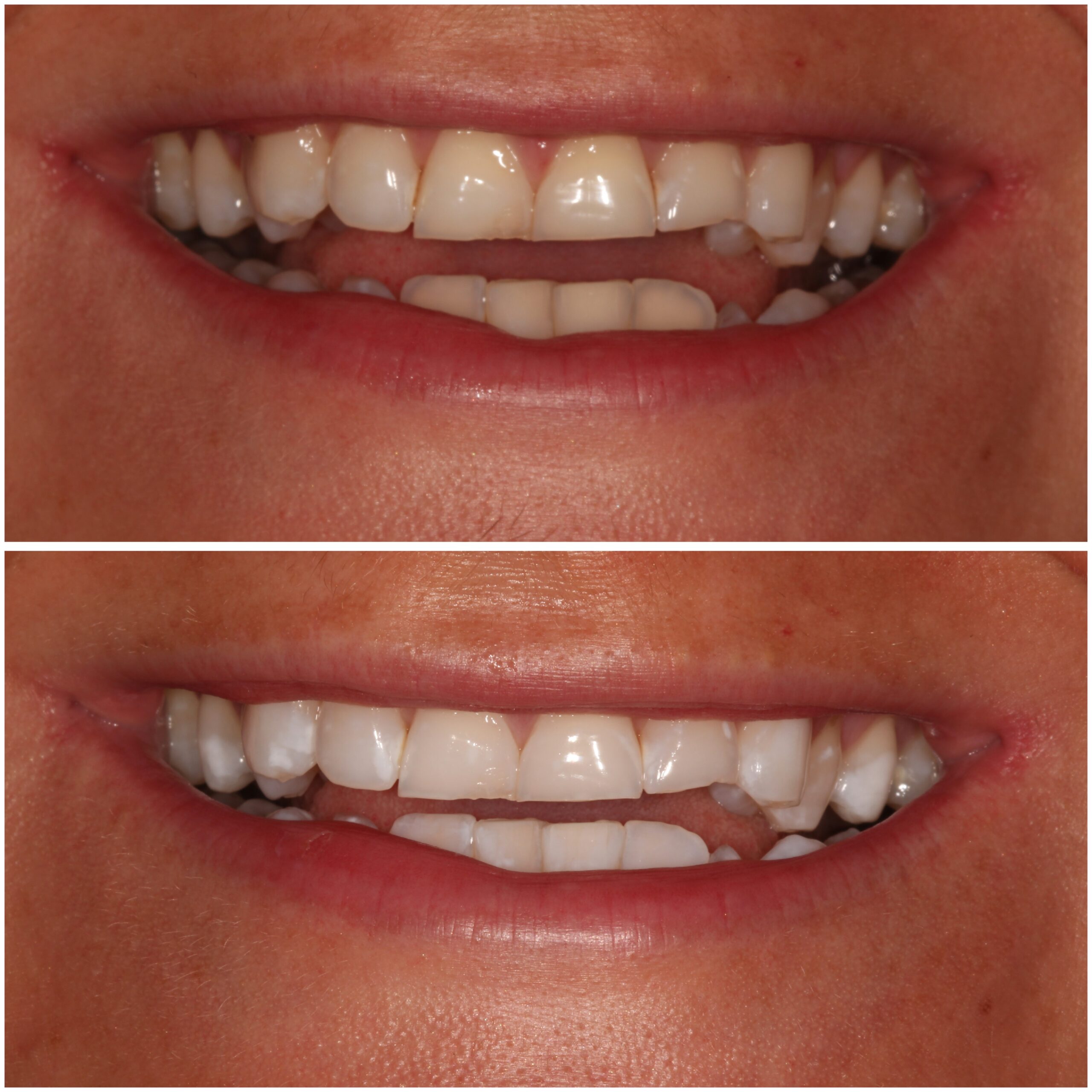 Teeth Whitening Marylebone