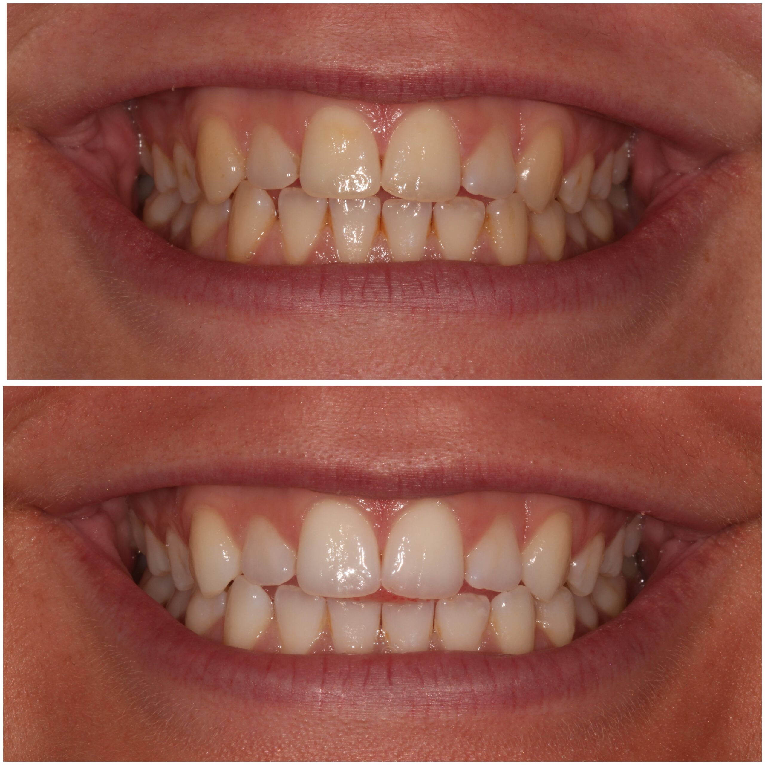 Teeth Whitening Marylebone