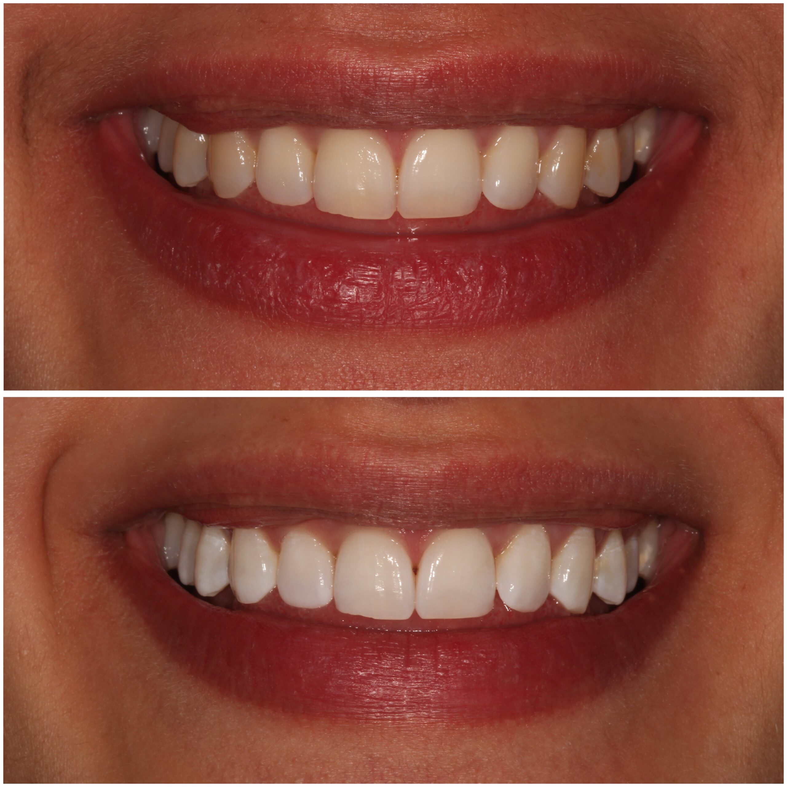 Teeth Whitening Marylebone