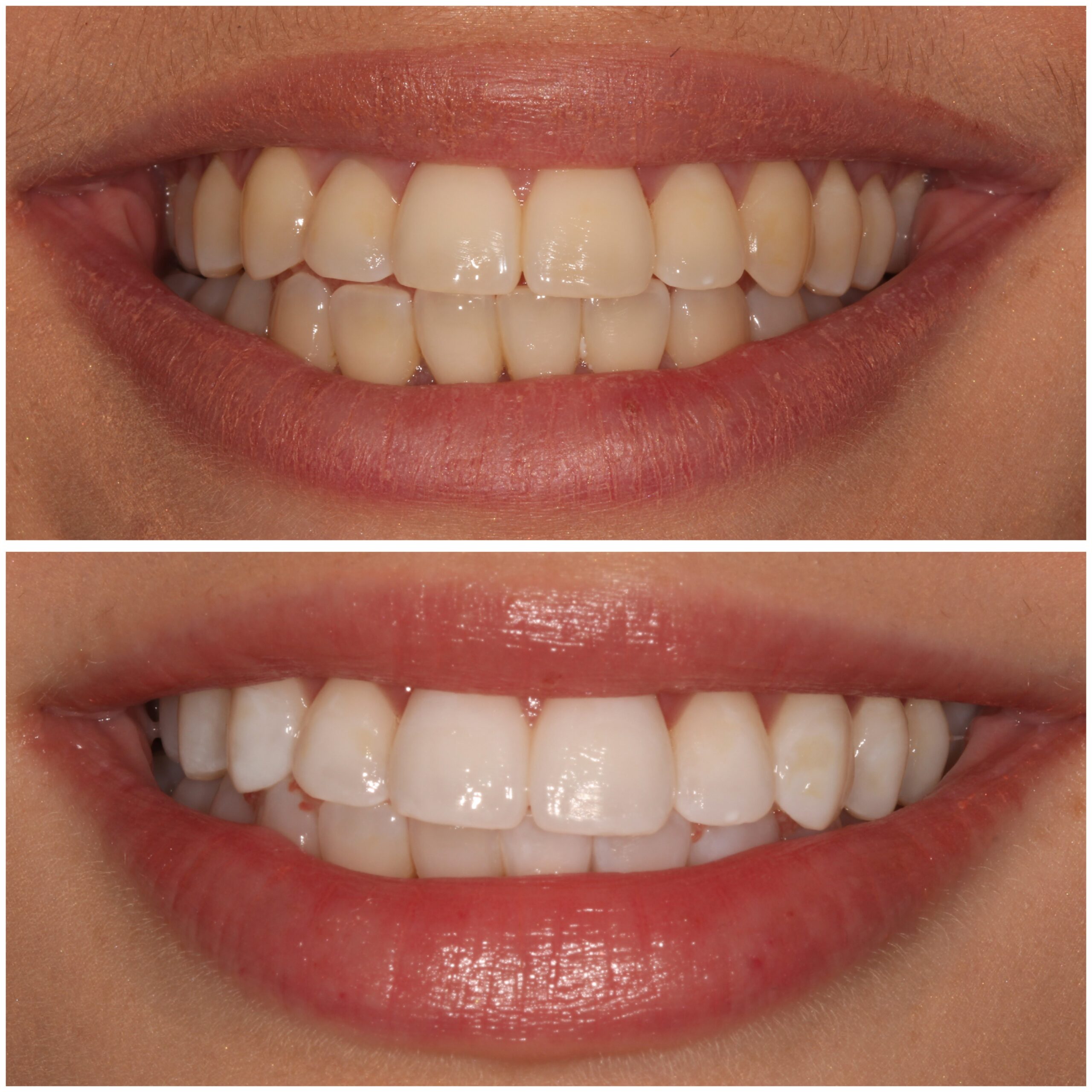 Teeth Whitening Marylebone