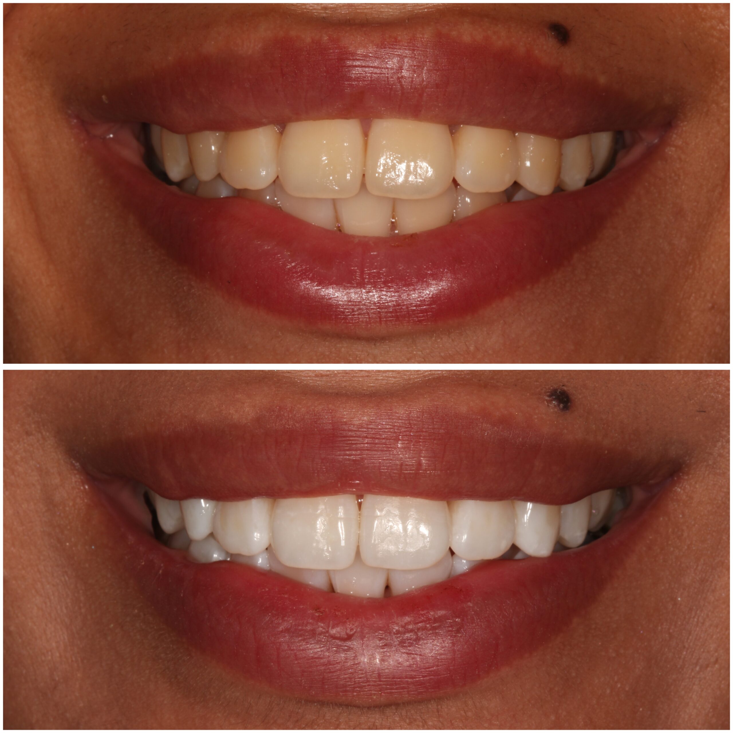 Teeth Whitening Marylebone