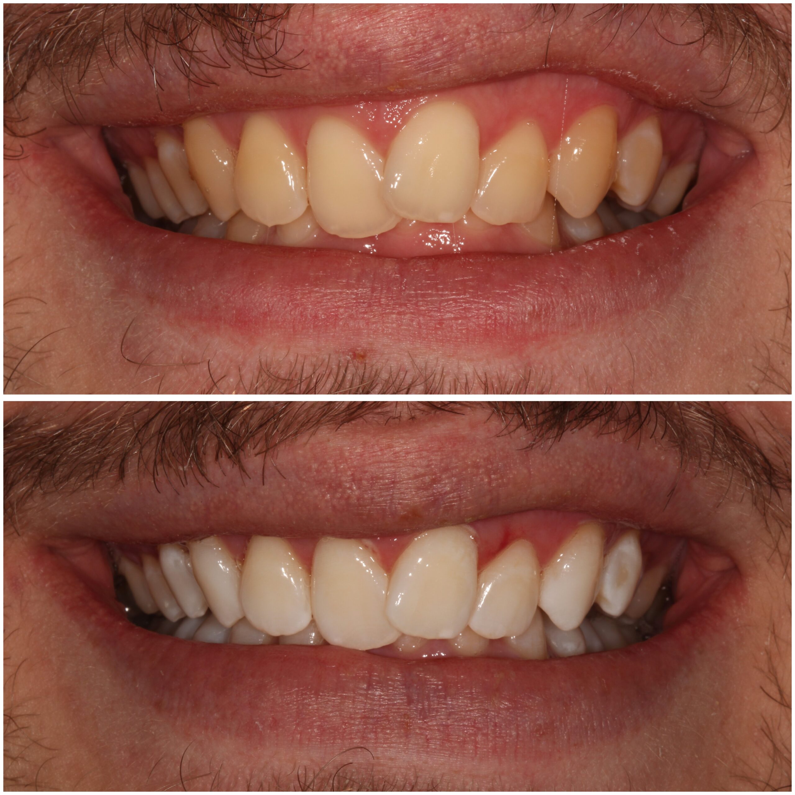 Teeth Whitening Marylebone