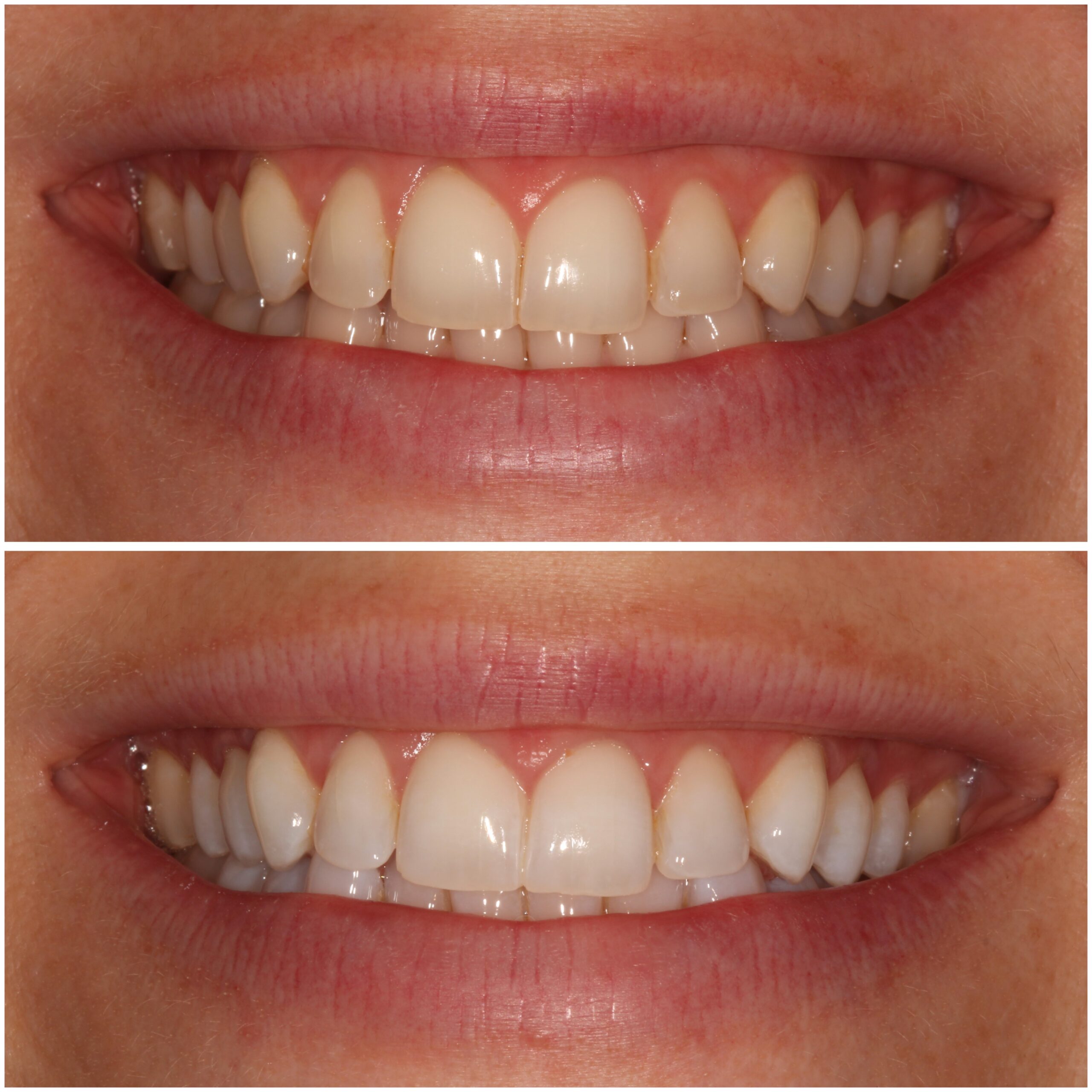 Teeth Whitening Marylebone