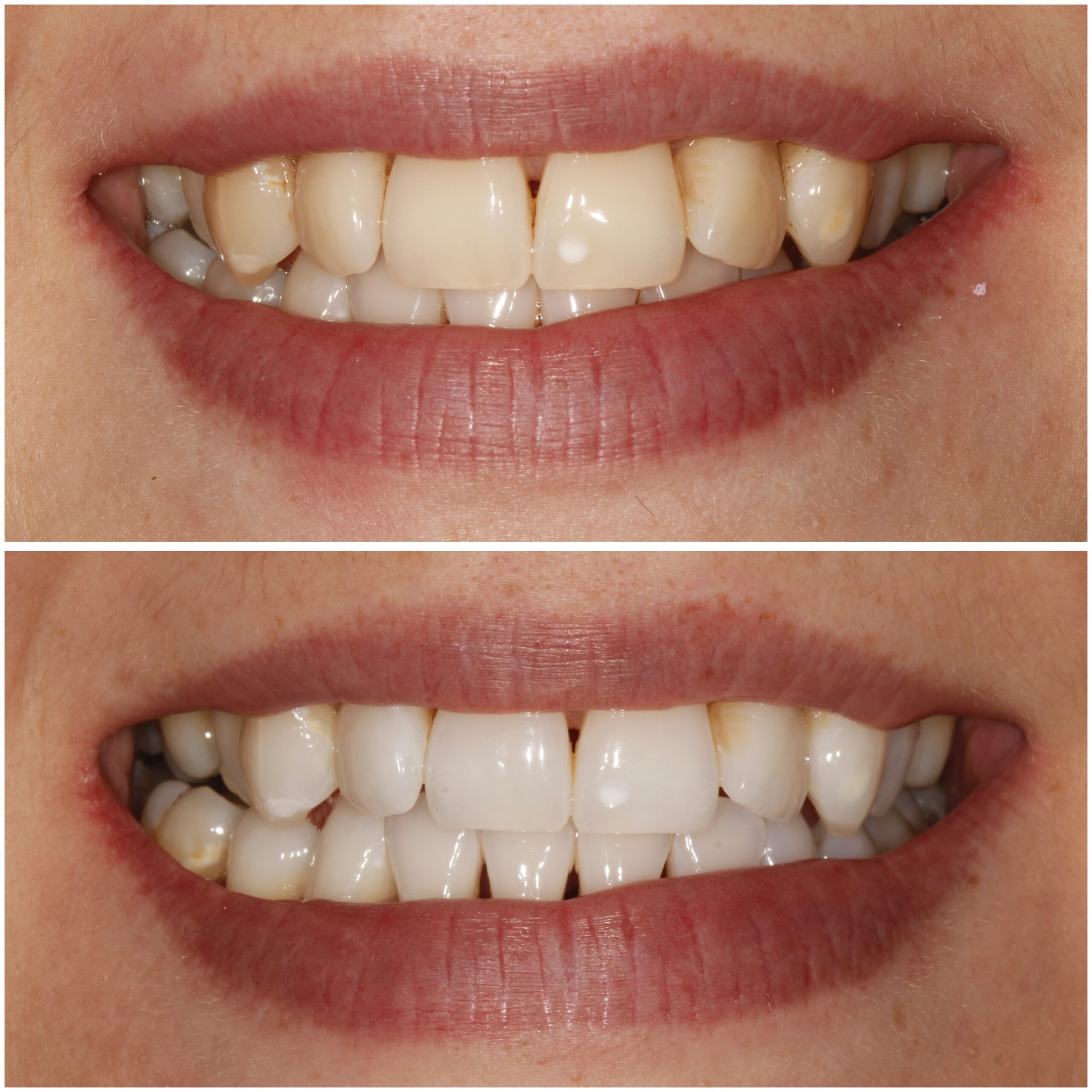 Teeth Whitening Marylebone
