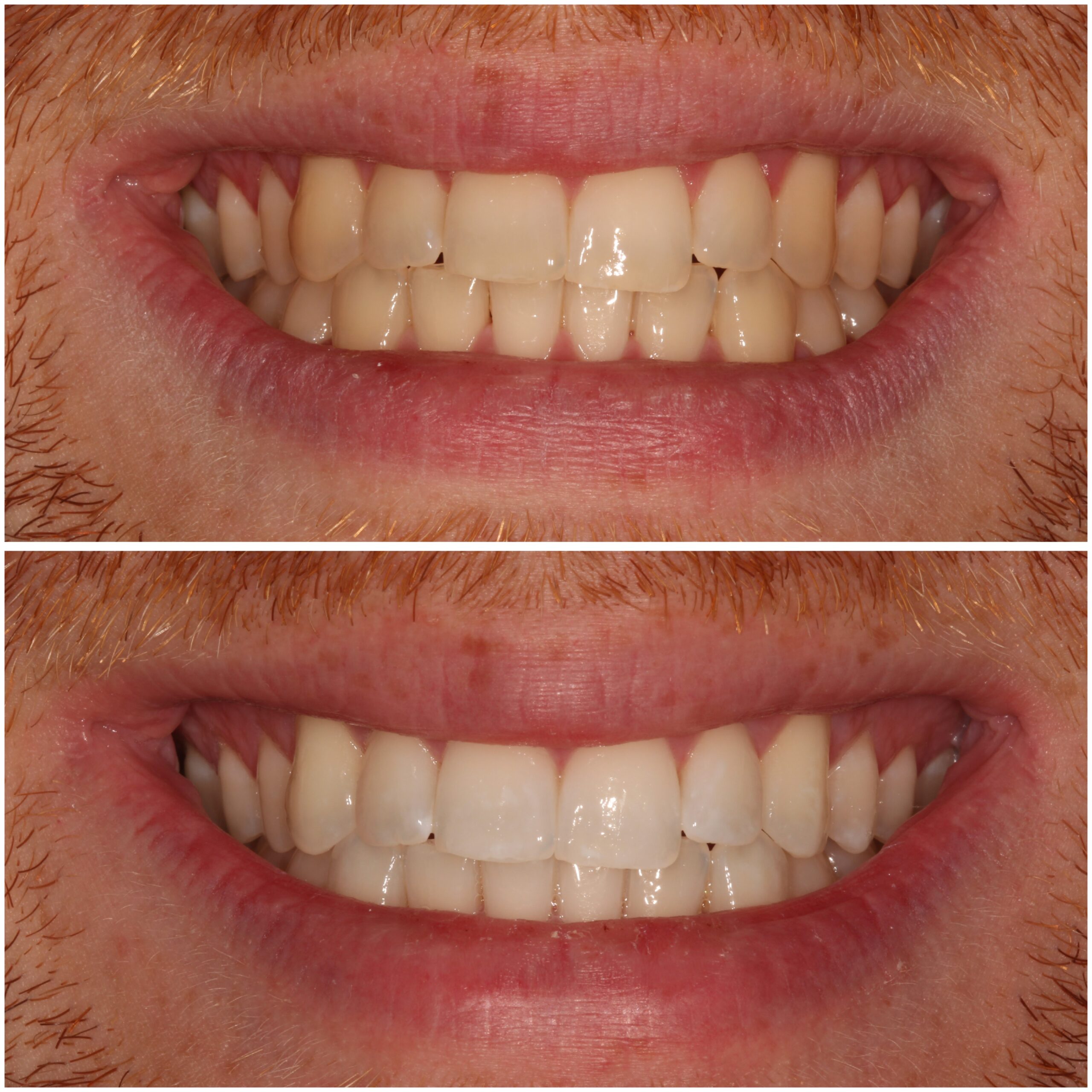 Teeth Whitening Marylebone