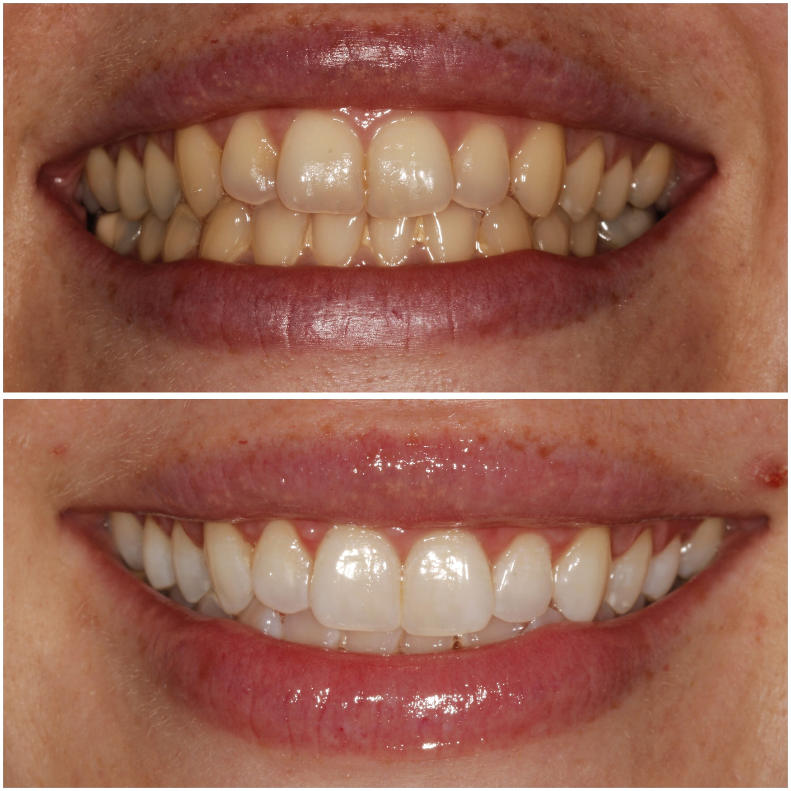 Teeth Whitening Marylebone