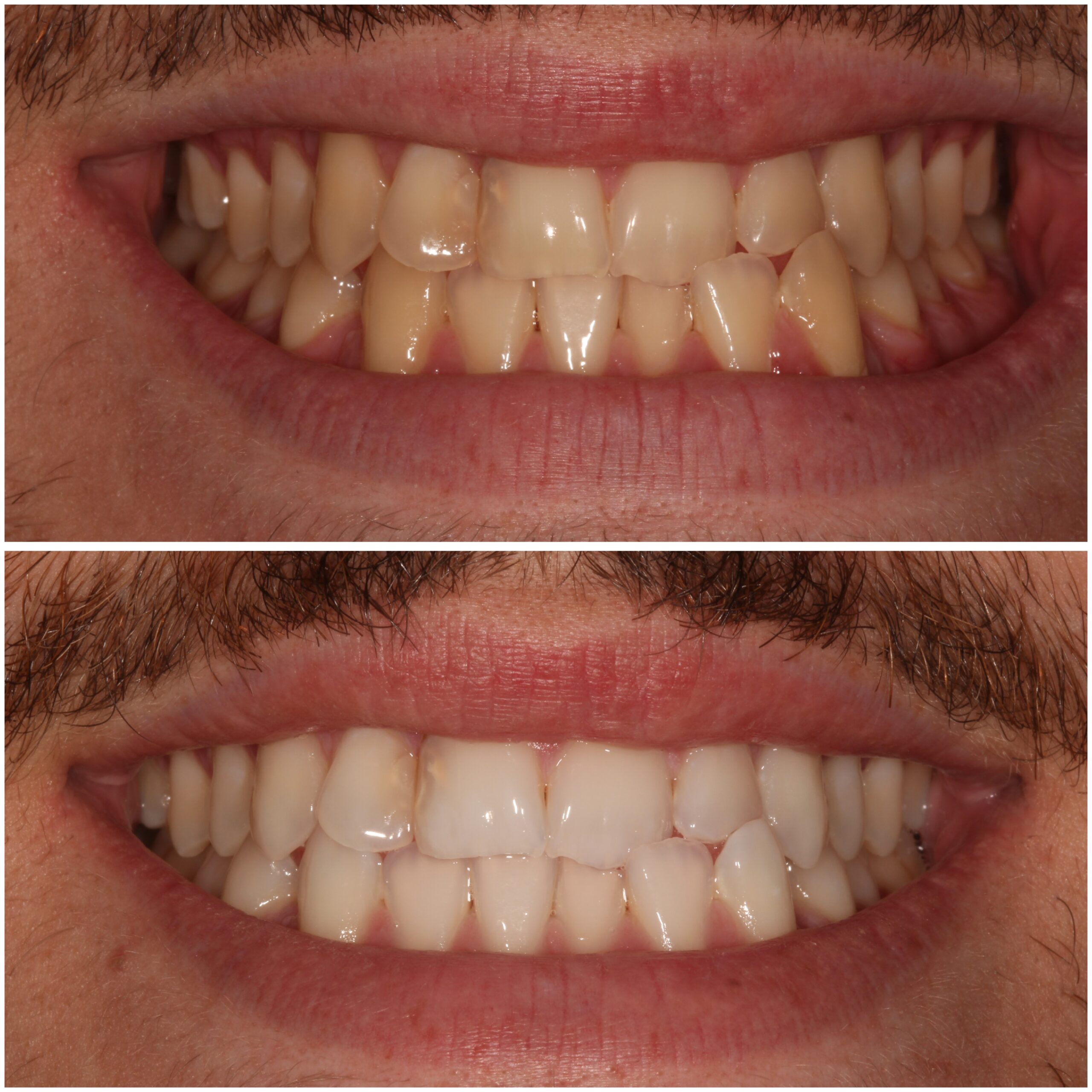 Teeth Whitening Marylebone